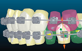Insignia customized orthodontic brackets