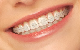Clear ceramic braces brackets close-up