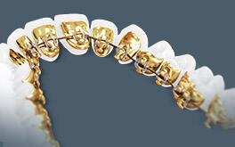 Incognito braces placed behind the teeth