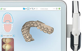 iTero digital scanner producing a 3D dental impression